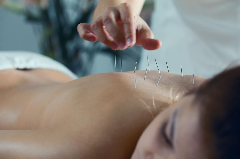 Acupuncture à Quevert